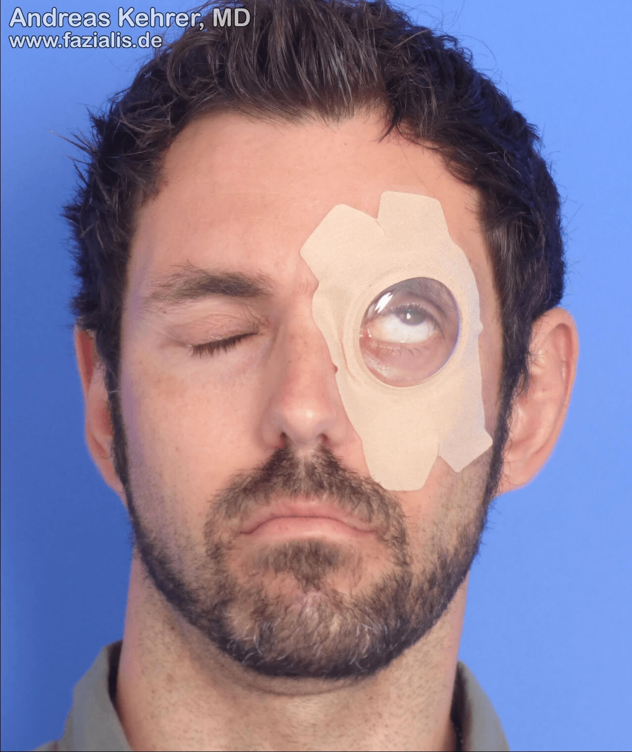 Auswirkungen Der Fazialisparese Am Augenkomplex Fazialis